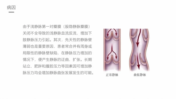 下肢静脉曲张护理专业教学PPT课件