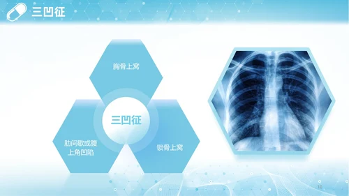 蓝色渐变简约商务呼吸困难的护理医学护理肺部培训PPT模板呼吸衰竭
