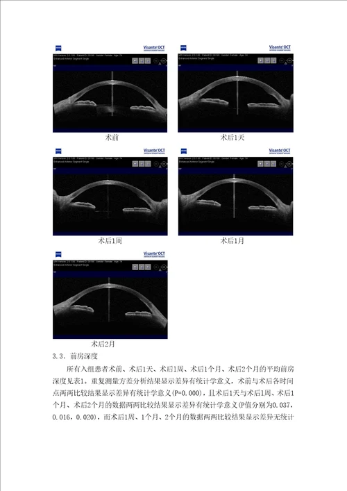 超声乳化白内障吸除联合人工晶状体植入术后角膜厚度、前房深度及房角的前节OCT观察眼科学专业毕业论文