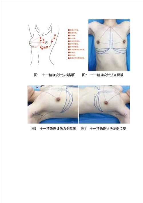 内窥镜辅助假体隆乳的术前精确设计和术中精准控制