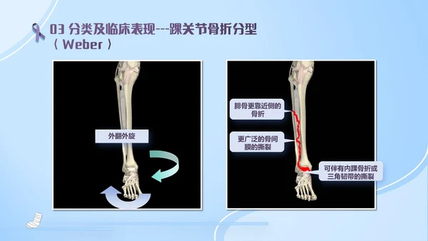 蓝紫色医疗风踝关节骨折护理查房护理PPT模板pptx