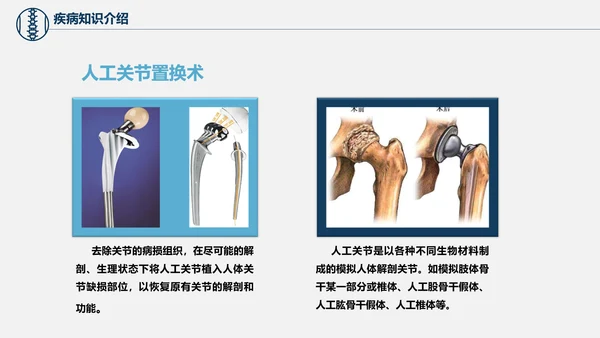 股骨颈骨折术后护理查房培训教学PPT课件