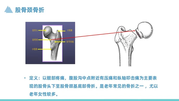 蓝色简约风股骨颈骨折护理查房培训课件
