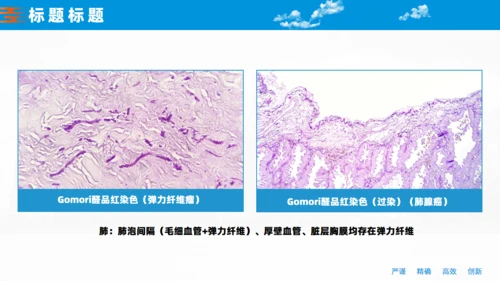 非小细胞肺癌的胸膜侵犯医学课件通用PPT模板
