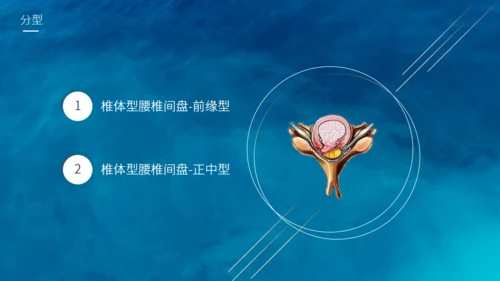 腰椎间盘突出护理查房通用PPT模板