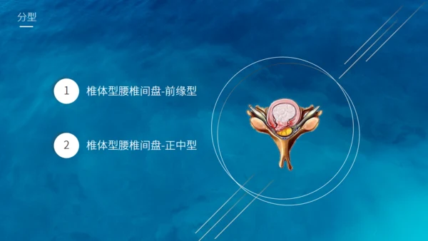 腰椎间盘突出护理查房通用PPT模板