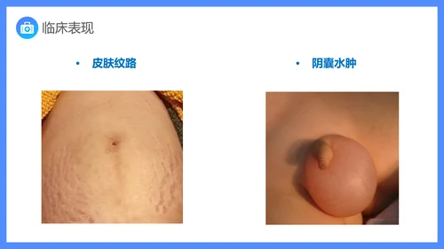 原发性肾病综合症医疗护理查房PPT课件模板