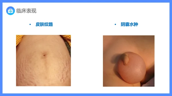 原发性肾病综合症医疗护理查房PPT课件模板