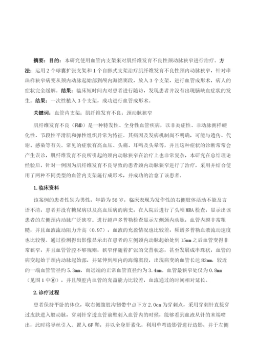 血管内支架治疗肌纤维发育不良性颈内动脉狭窄观察.docx