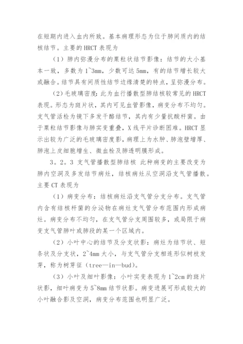 肺结核护理毕业论文.docx